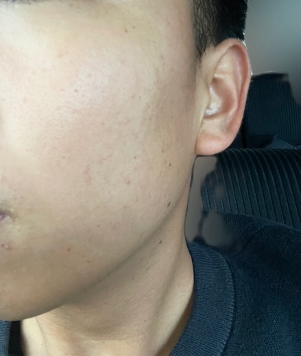 before photo: ダーマペン