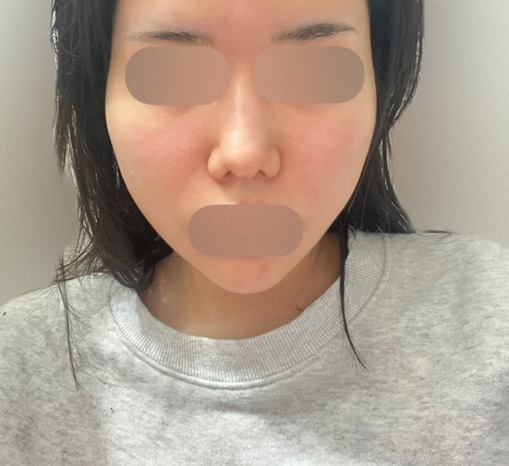 before photo: 糸リフト