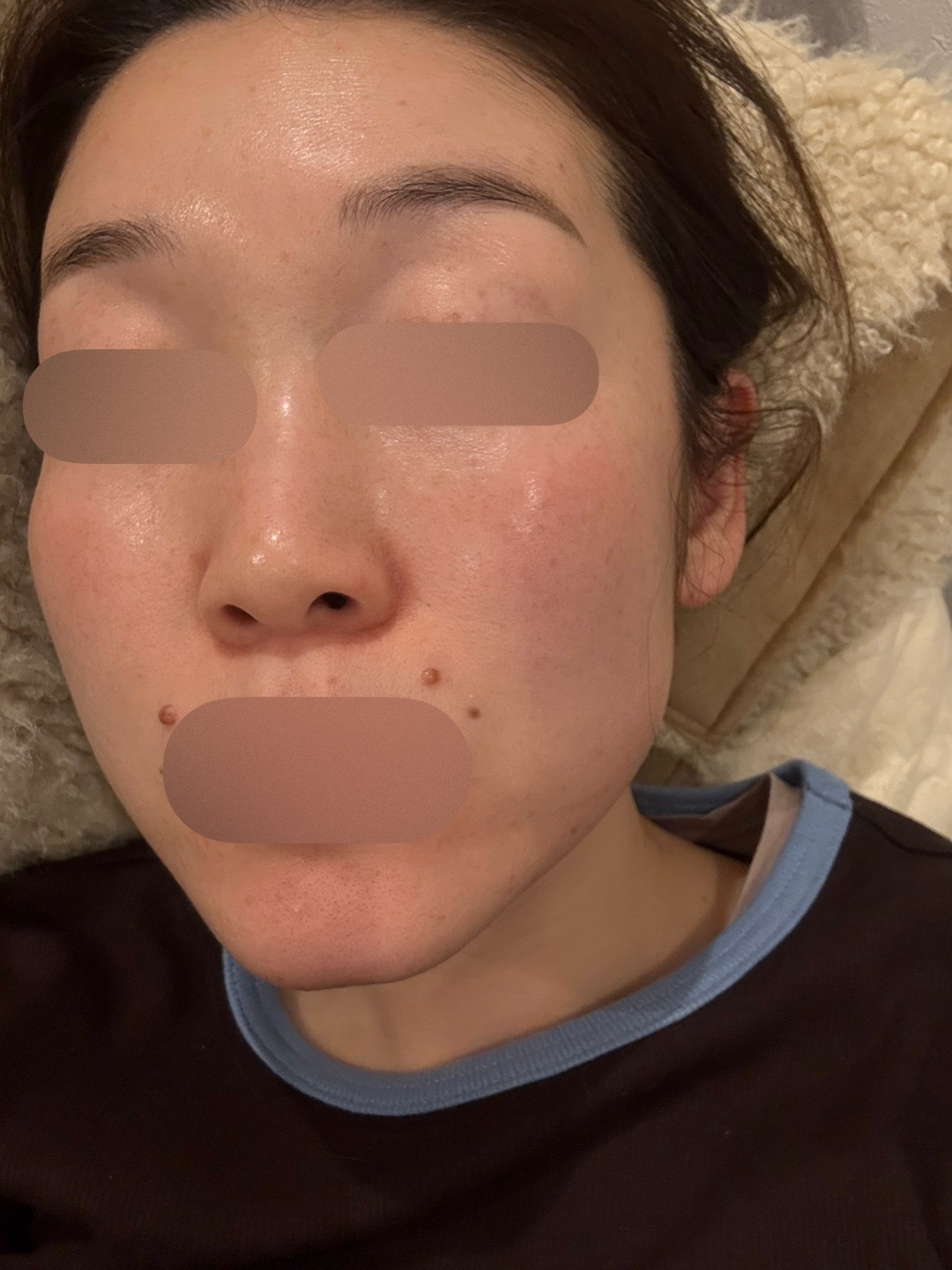 ピコトーニング＋マッサージピール【2月15日迄にご予約頂いた方】 | ZX