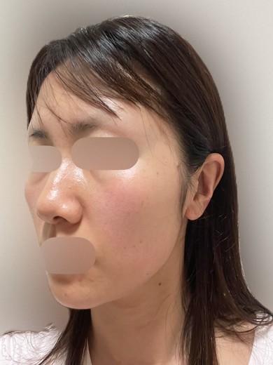 after photo: ルメッカ