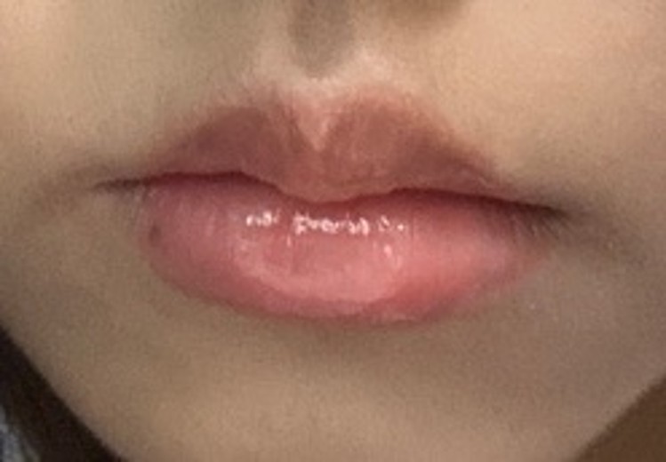 before photo: 입술필러