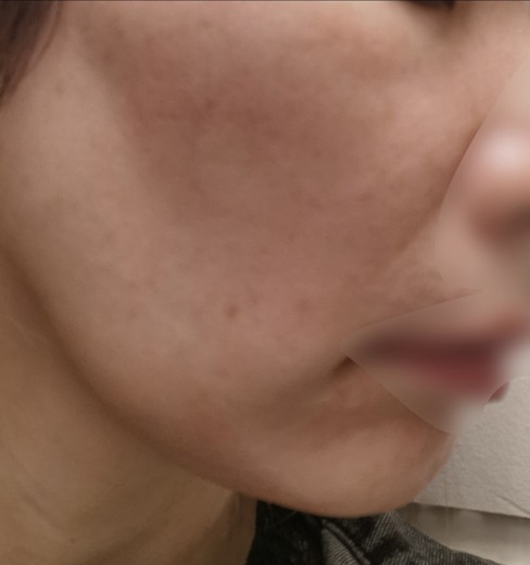 before photo: IPL(光/フォト治療)