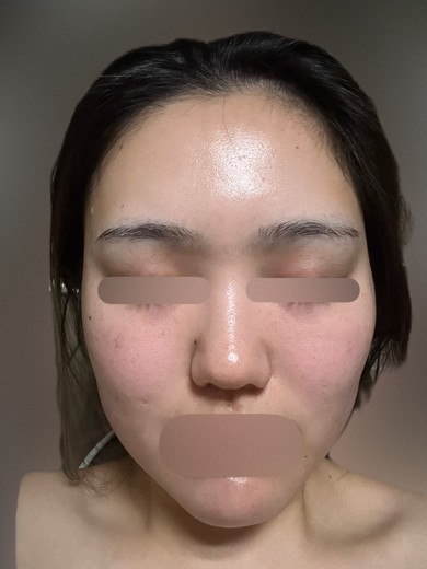 after photo: ダーマペン