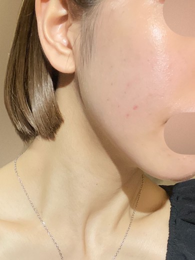 after photo: IPL(光/フォト治療)