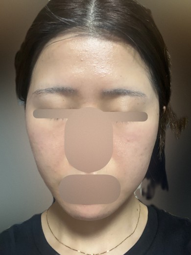 before photo: ピーリング, エレクトロポレーション