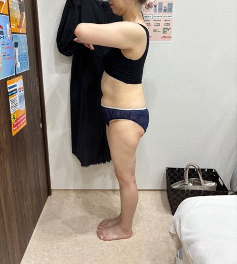 after photo: 脂肪冷却(腹部)