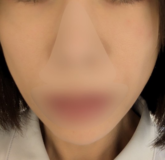after photo: 糸リフト, メーラー/ジョール/バッカルファット除去