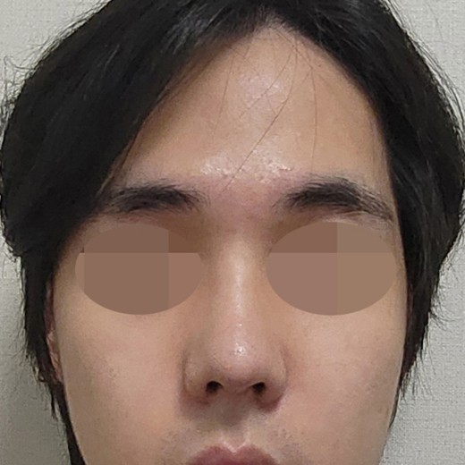 after photo: 코끝(자가연골)