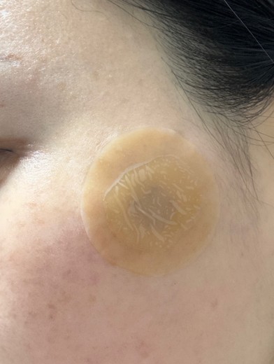 after photo: 리팟레이저