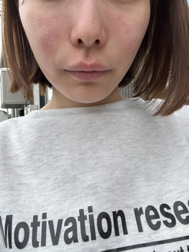 before photo: ほうれい線ヒアルロン酸