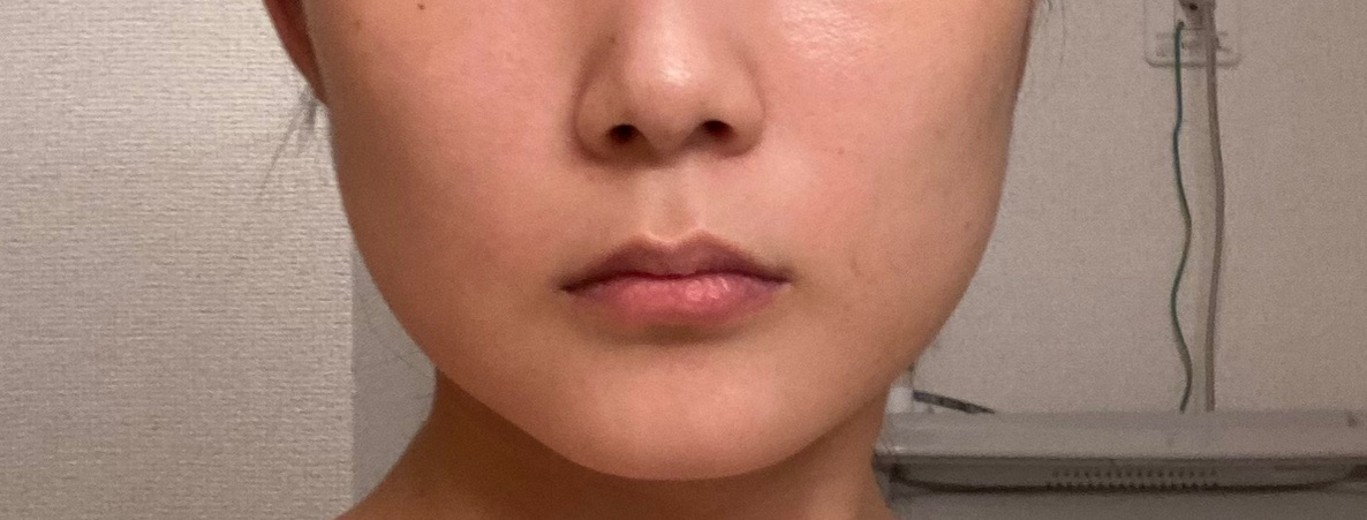 after photo: ボルニューマ