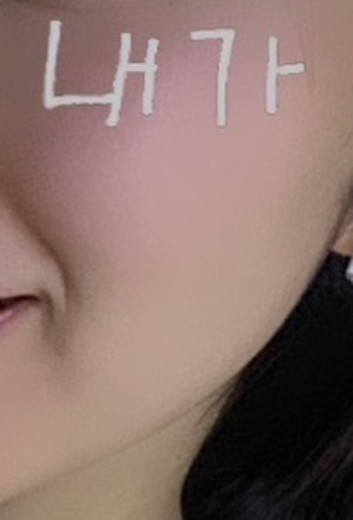 after photo: 튠페이스리프팅, 티타늄리프팅