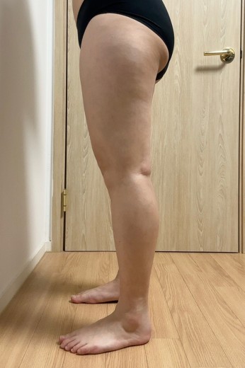 before photo: 허벅지지방흡입