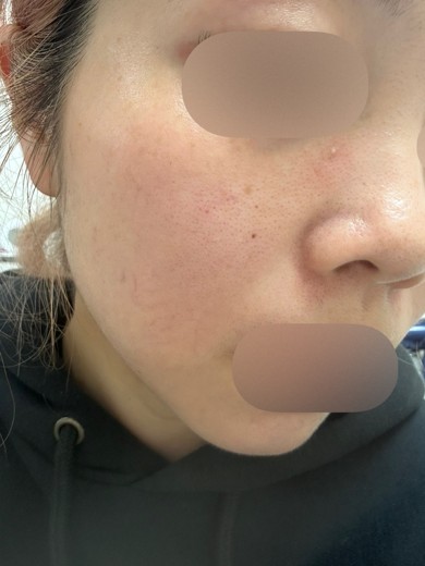 before photo: IPL(光/フォト治療)