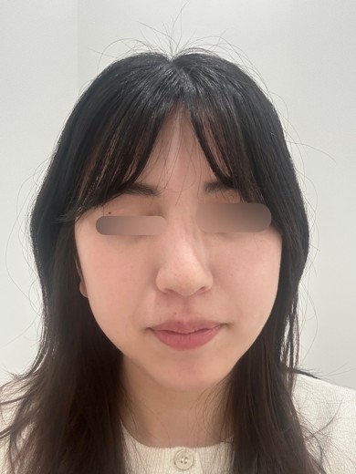 before photo: ミラノリピール
