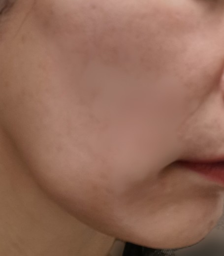 after photo: IPL(光/フォト治療)