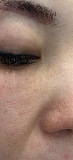 before photo: ハイドラフェイシャル