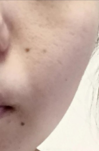 before photo: IPL(光/フォト治療), 診断・検査