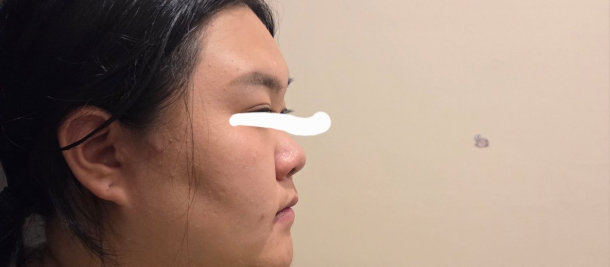 before photo: 비중격만곡증수술, 코끝(보형물)