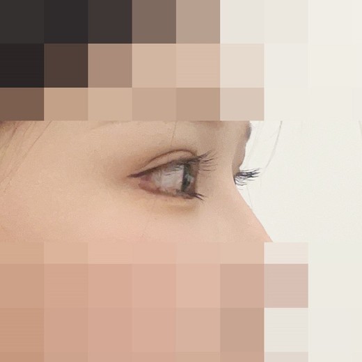 after photo: 밑트임, 뒤트임