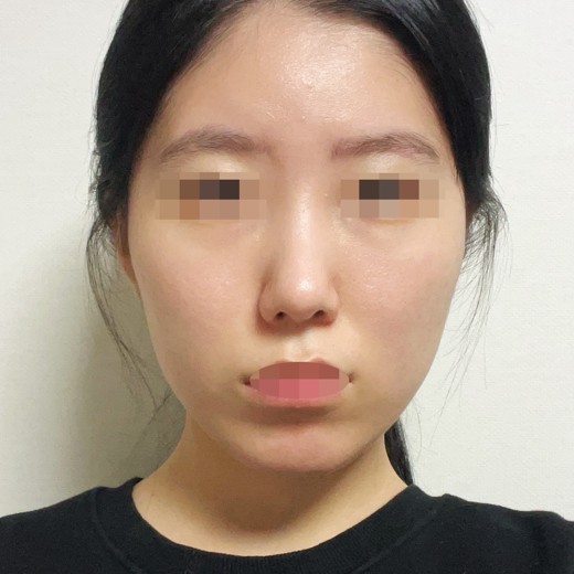 after photo: 코끝(자가연골)