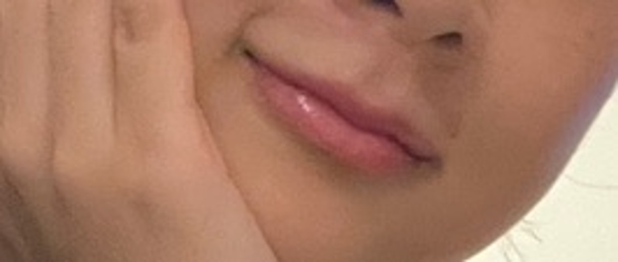 after photo: 입술필러