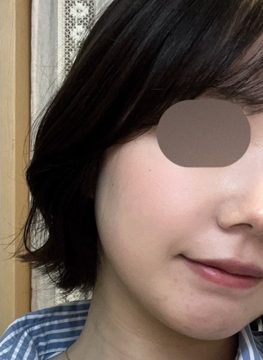 before photo: ピーリング, 診断・検査