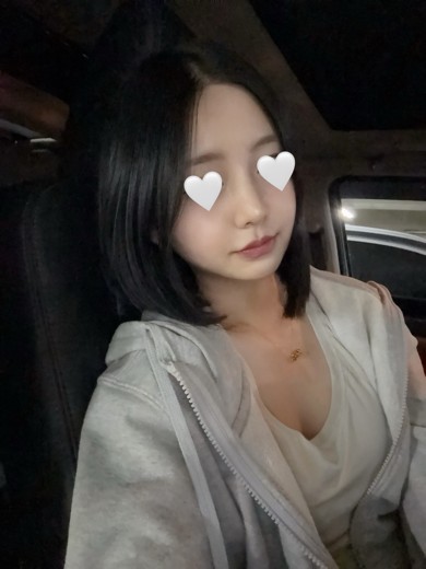 after photo: 콧대(보형물), 코끝(자가연골)