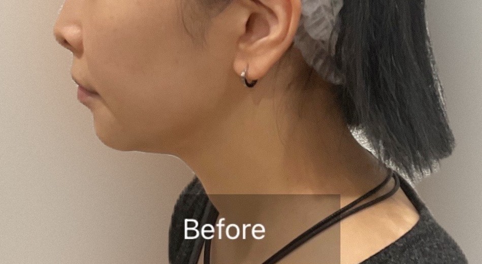 before photo: チタニウムリフト, マッサージピール(コラーゲンピール)