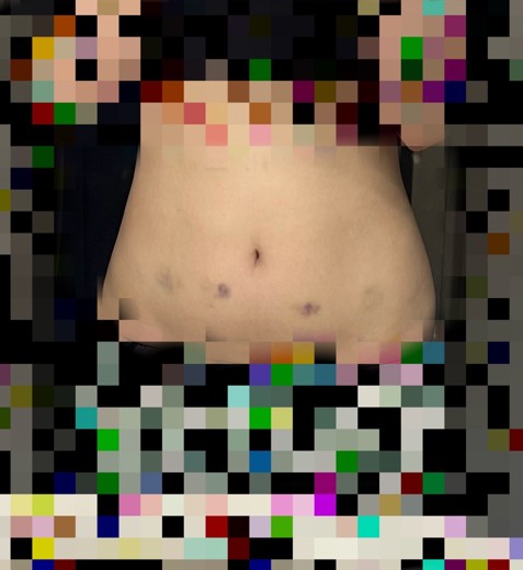 after photo: 脂肪溶解注射(腹部)