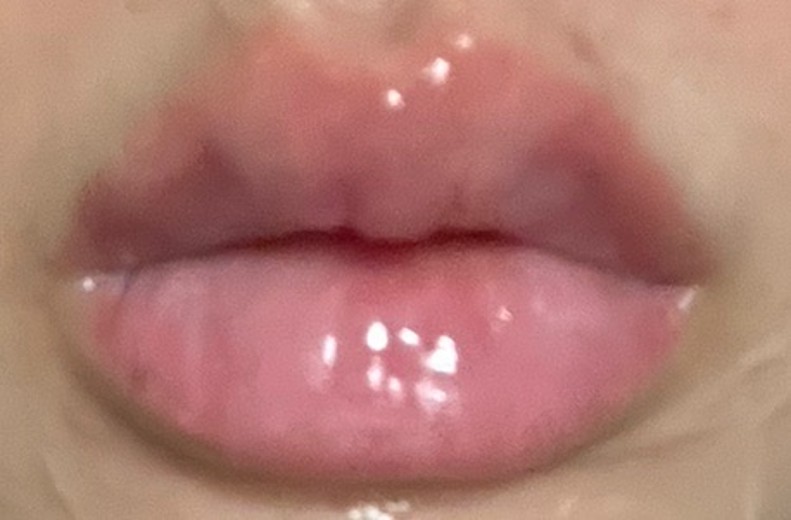 after photo: 입술필러