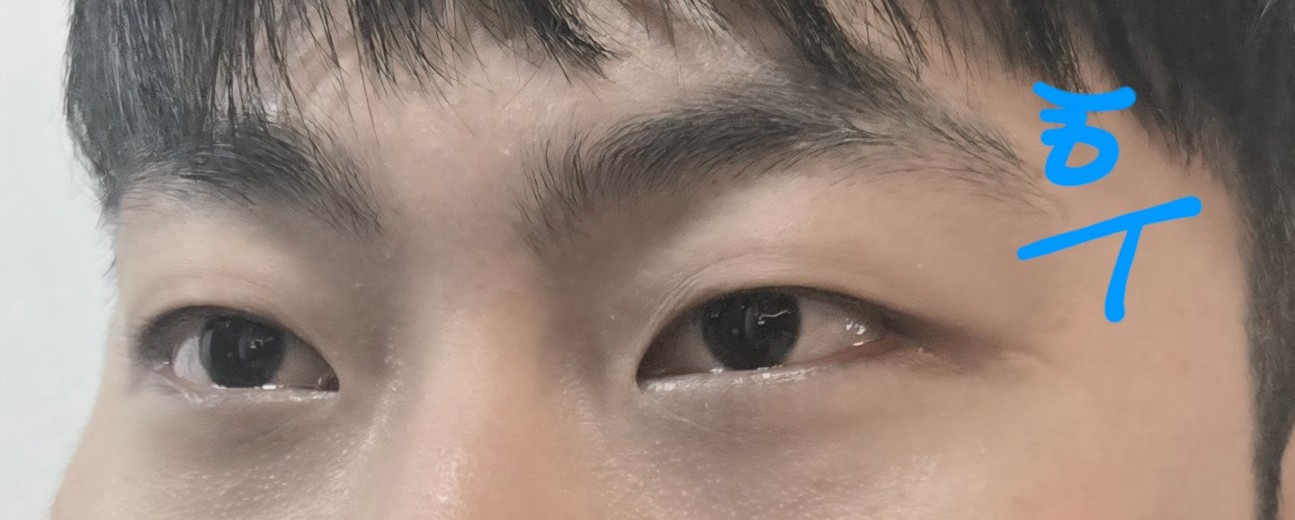 after photo: 입술필러