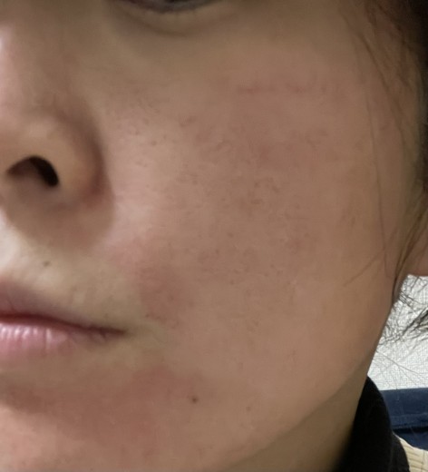 after photo: ダーマペン