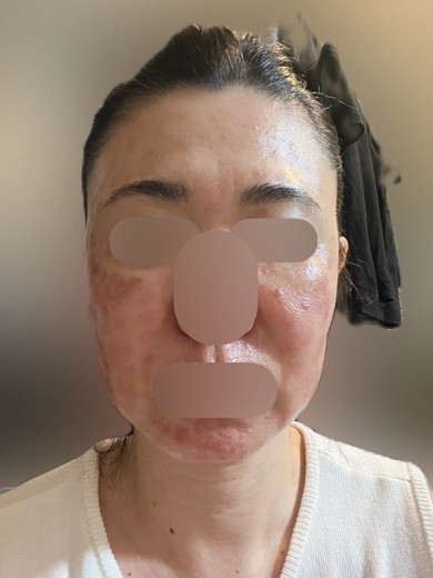 after photo: フラクショナルレーザー