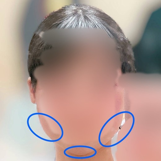 after photo: 脂肪溶解注射(顔)