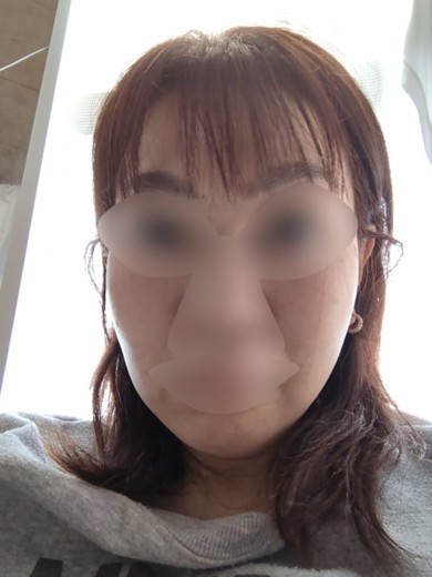 after photo: 脂肪溶解注射(顔)