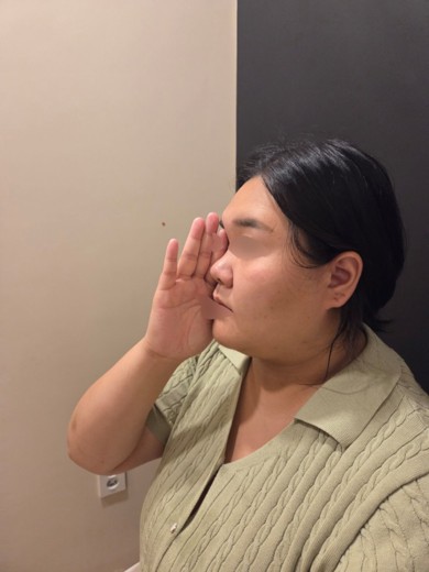 before photo: 비중격만곡증수술, 코끝(보형물)