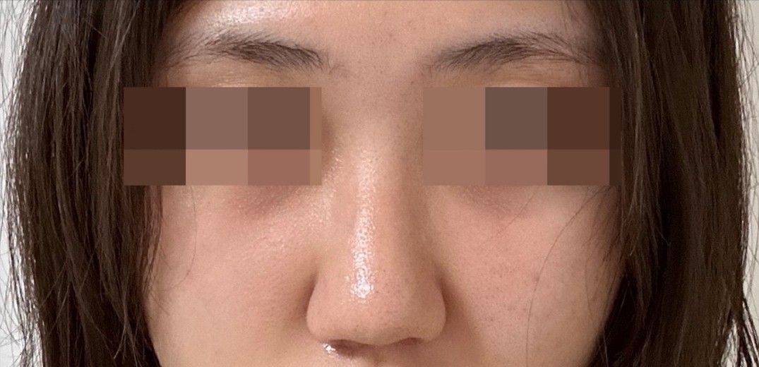 after photo: 콧볼축소