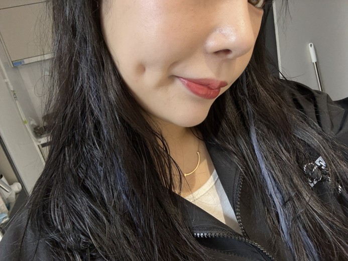 after photo: 보조개성형