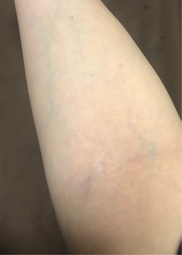 after photo: ビタミン注射・点滴