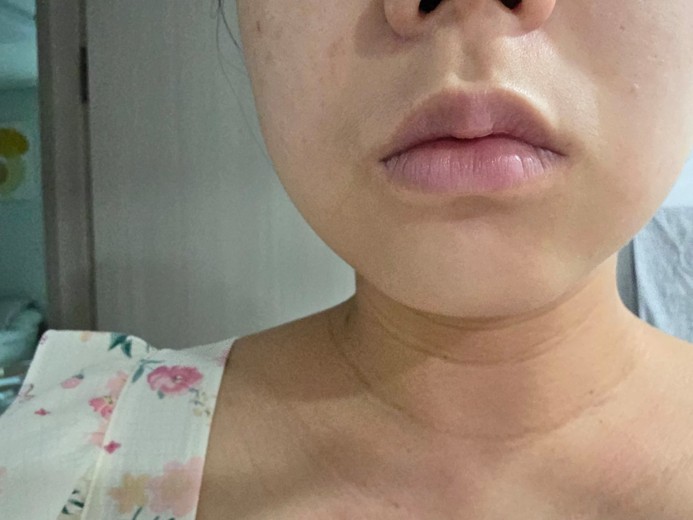 before photo: 이마필러