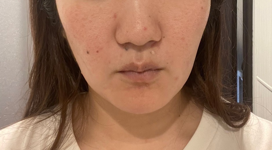 after photo: IPL(光/フォト治療)