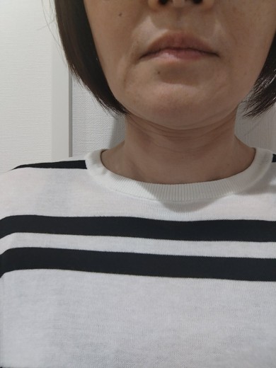 before photo: ピコトーニング
