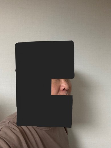 after photo: 눈밑지방재배치