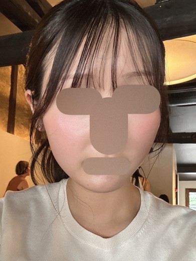 after photo: ピーリング