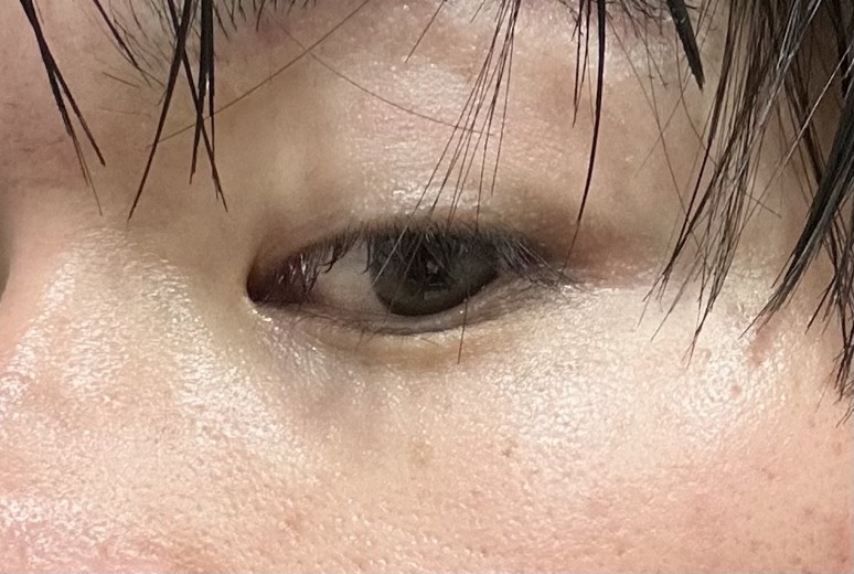 after photo: 眼瞼下垂(目つき矯正)