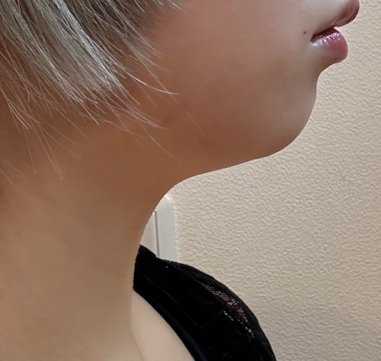 after photo: 脂肪溶解注射(顔)