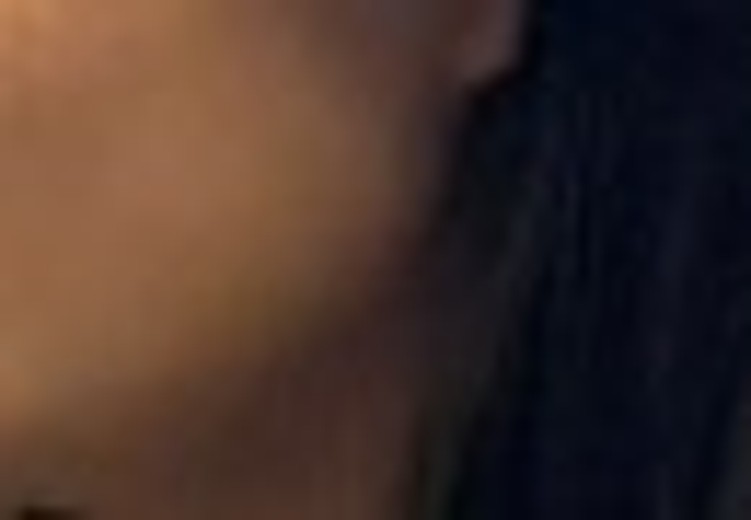 after photo: 사각턱보톡스