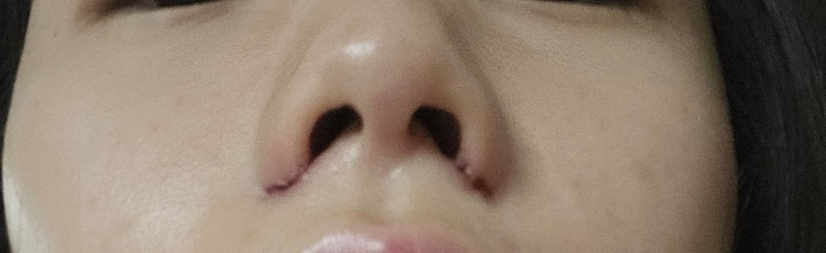 after photo: 콧볼축소