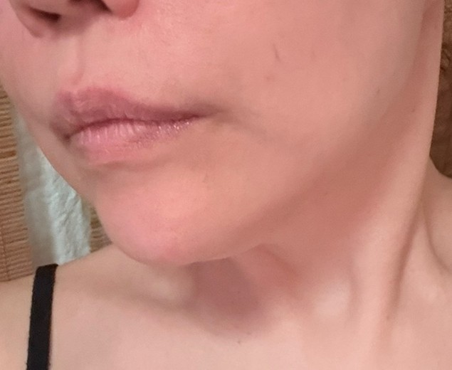 after photo: 脂肪溶解注射(顔)